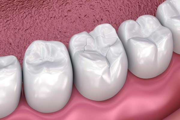 Cracked Tooth? Cosmetic Repair Options - Thanasas Family Dental