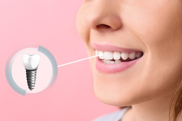 Recovery Tips After Getting Dental Implants